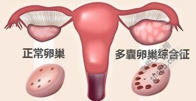 多囊卵巢综合症患者的成功怀孕经验